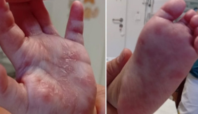 Kiskor&uacute; &eacute;s drogos anyuk&aacute;k: Borsodban h&aacute;rom csecsemő halt meg id&eacute;n velesz&uuml;letett szifiliszben